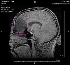 MRI of my  brain after surgery for Oligodendroglioma tumor